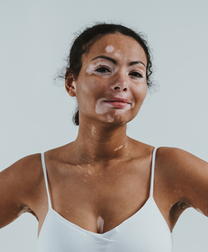 True/False: everything you need to know about vitiligo